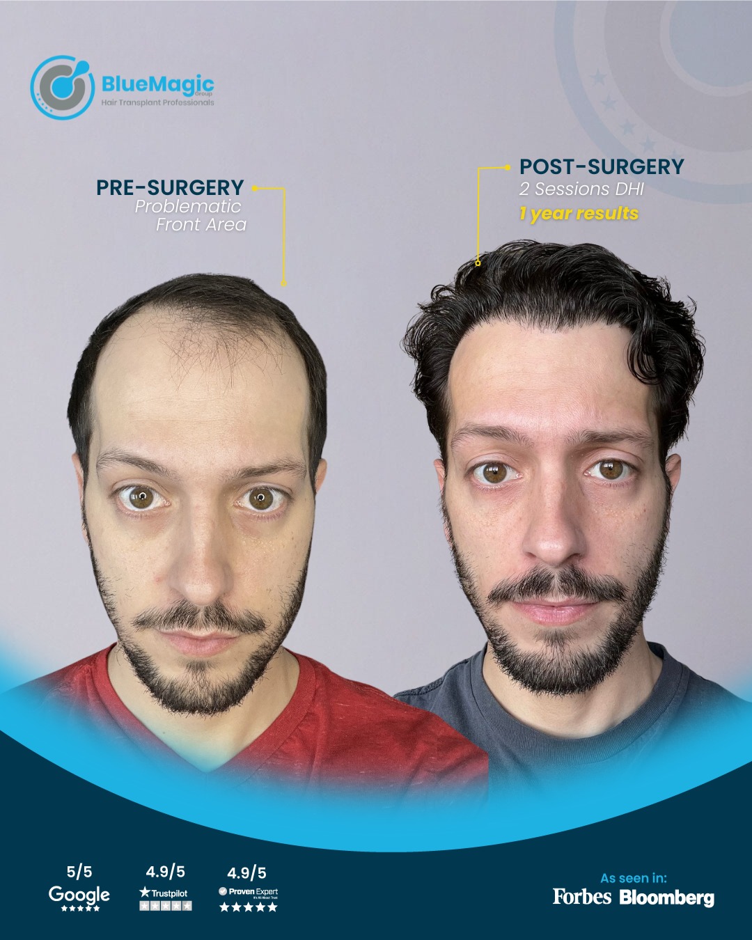hair transplant cost in Turkey