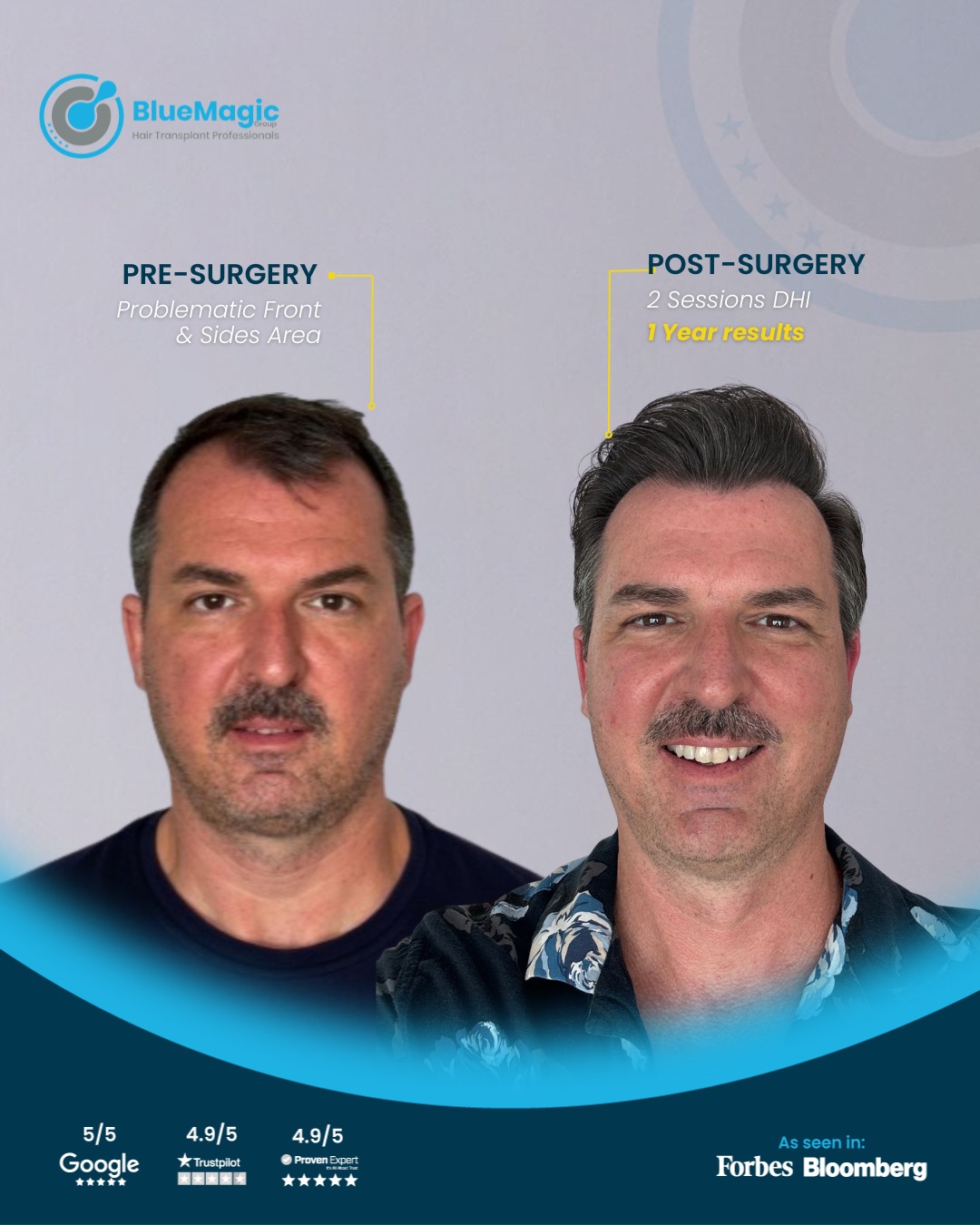 hair transplant clinic in Turkey