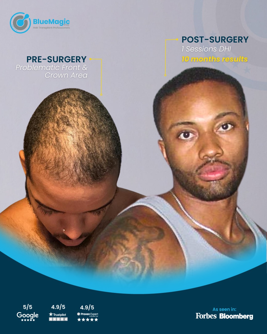 best hair transplant clinic in istanbul