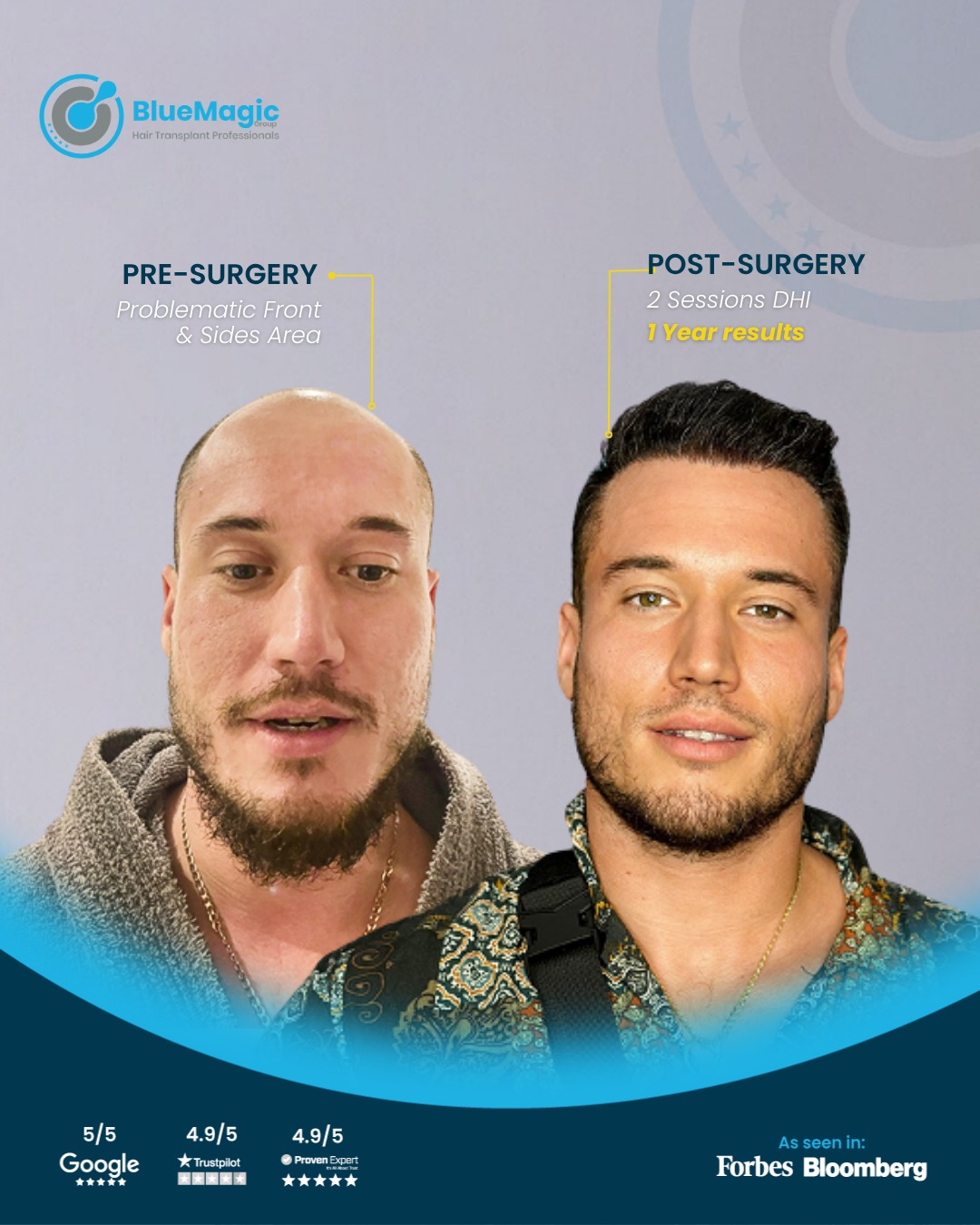 best hair transplant in Turkey