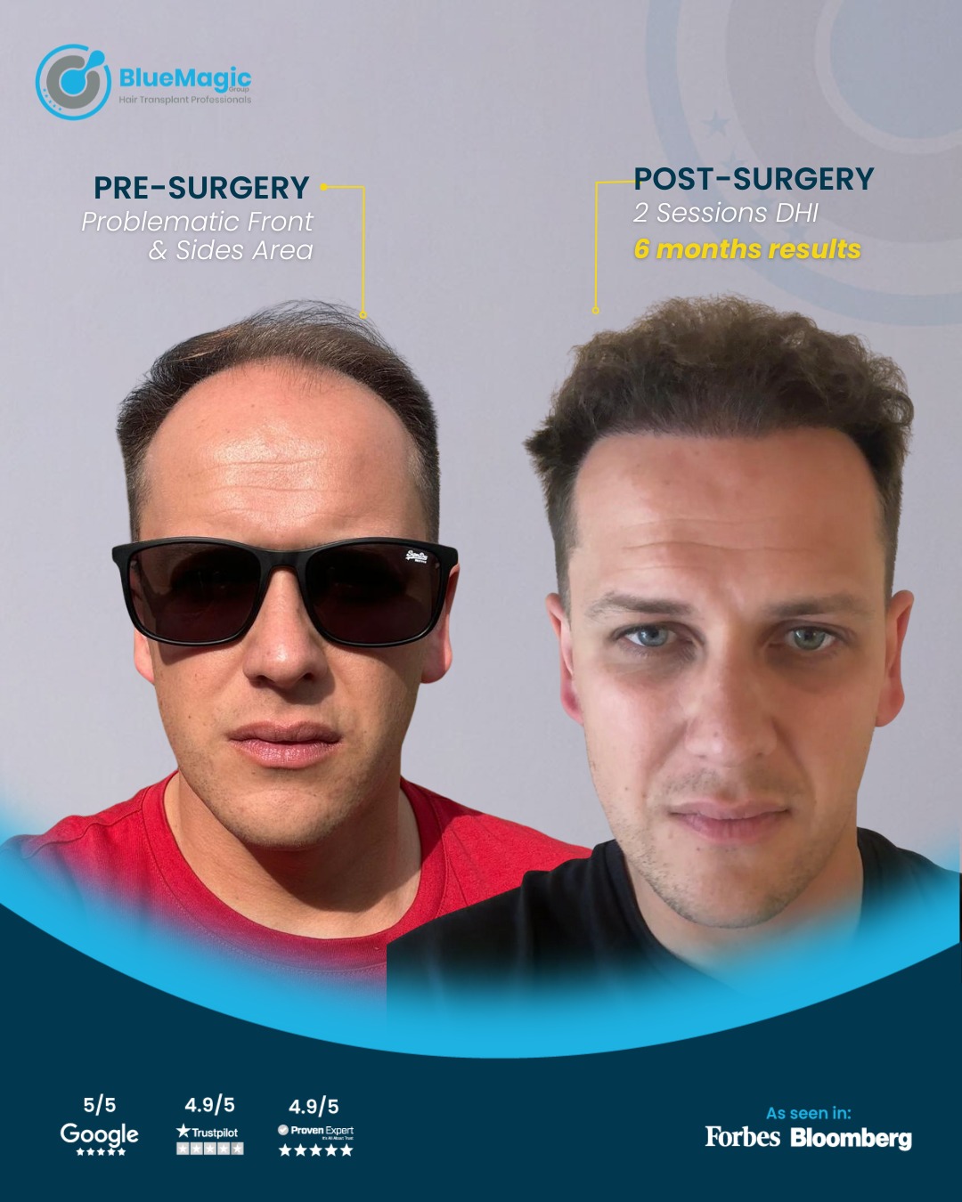 best hair transplant clinic in Turkey