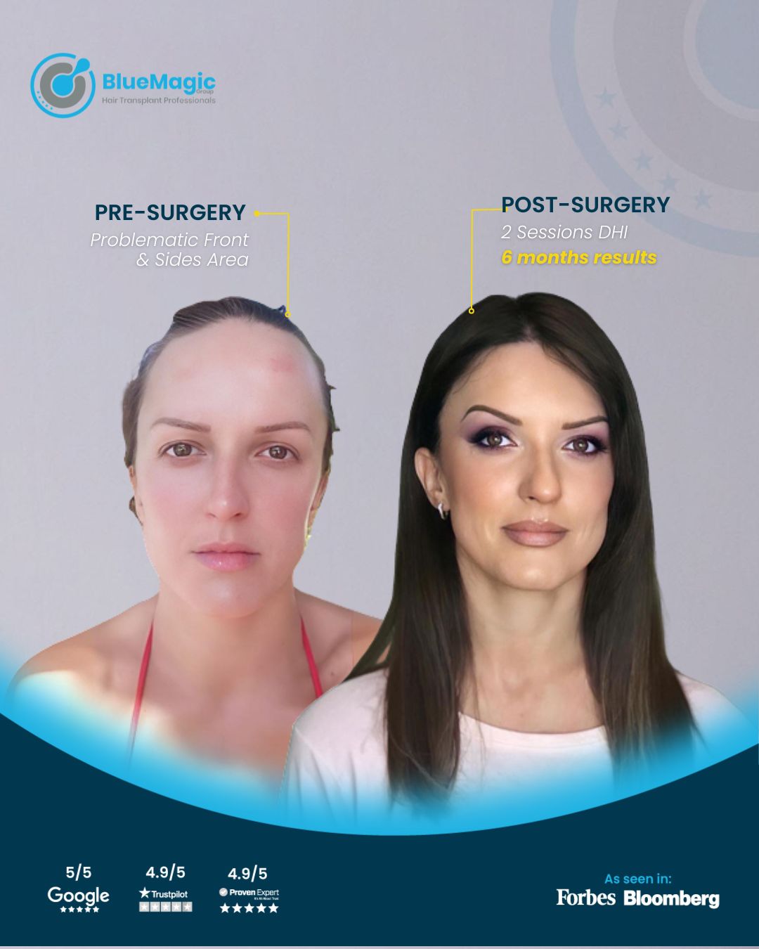 hair transplant clinic in Turkey